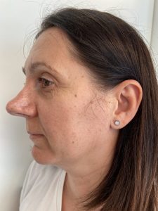 Rosacea Behandlung VORHER-NACHHER