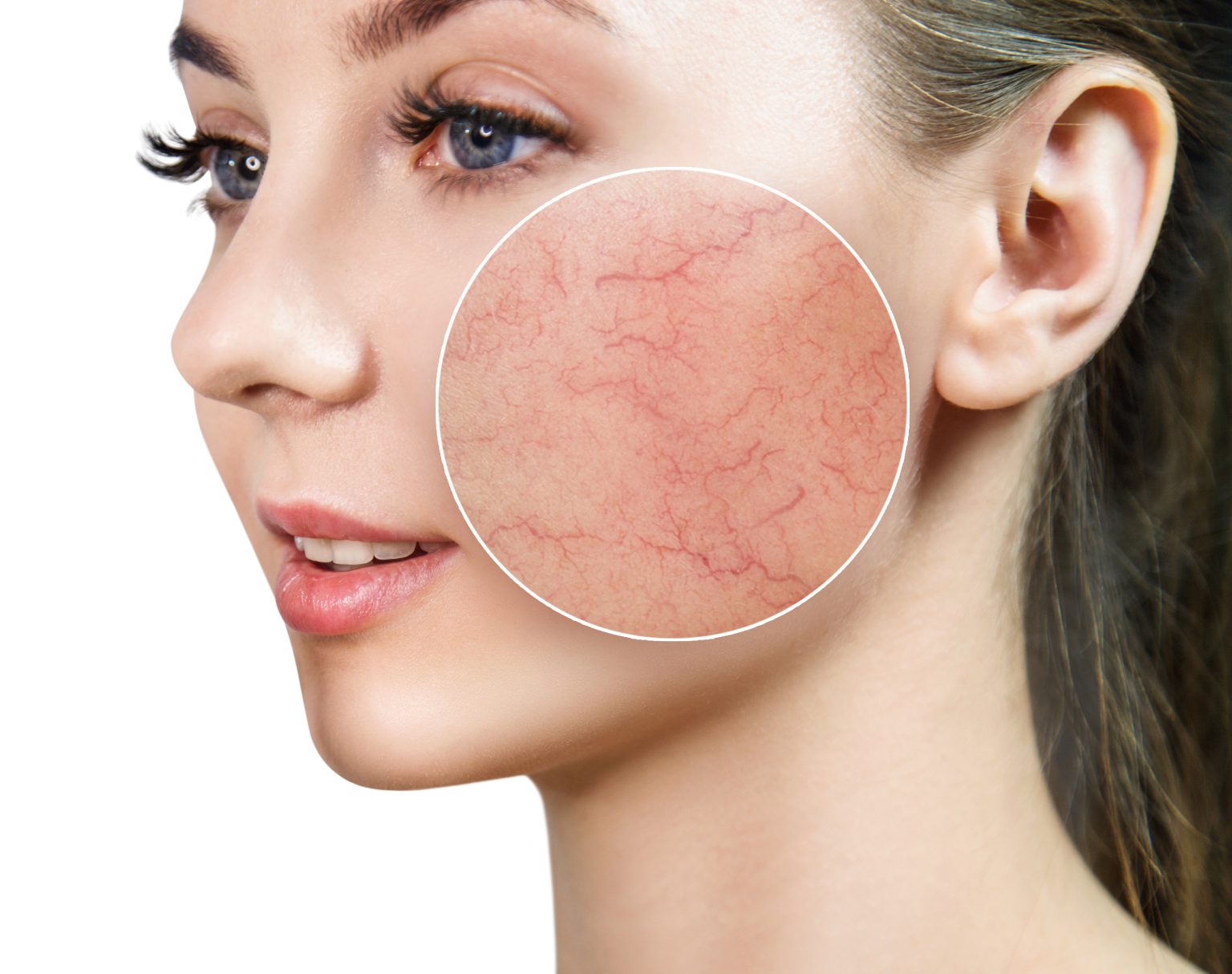 Rosacea Behandlung Wien Hautarzt Wien Dr Barbara Franz