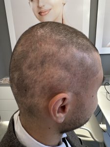 Nachher-Foto eines Patienten, der an Haarausfall leidet. Nach PRP Behandlung - Eigenblutbehandlung bei Haarausfall