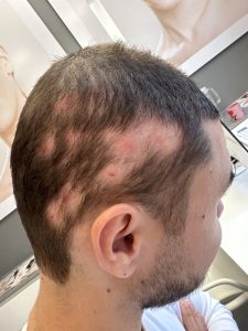 Vorher-Foto eines Patienten, der an Haarausfall leidet