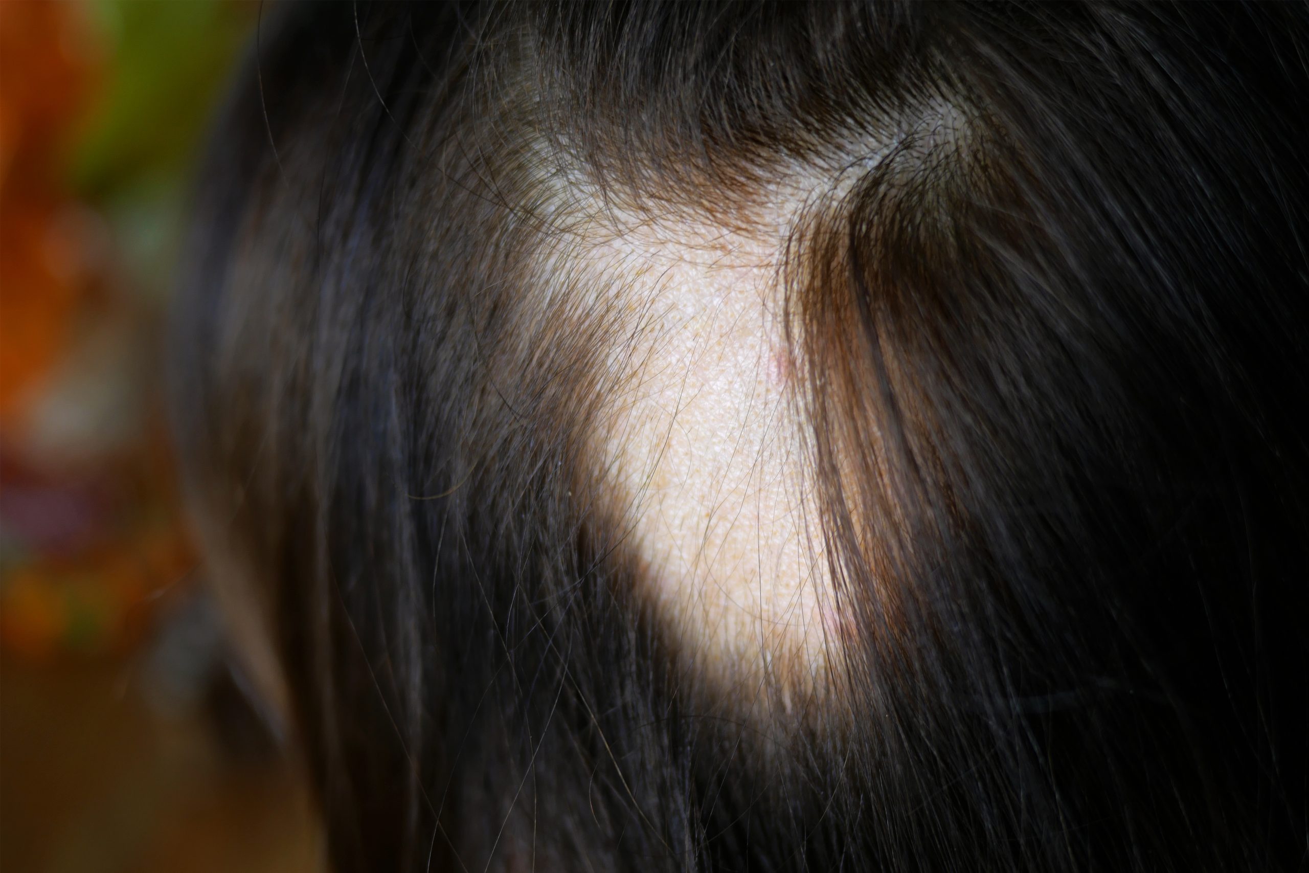 Kreisrunder Haarausfall bei Frau mit glatten braunen Haaren